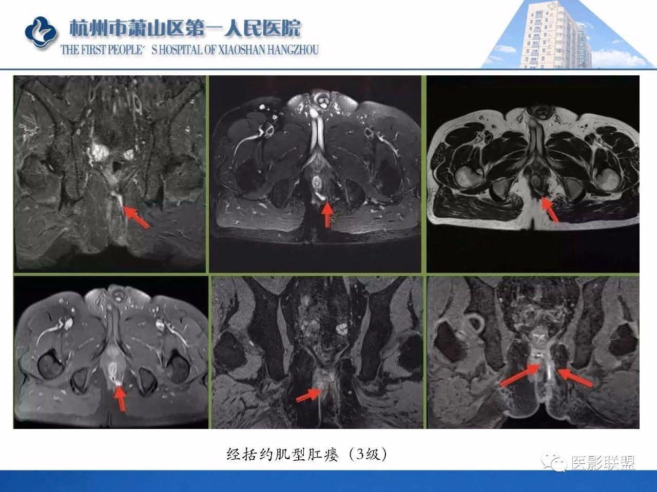 专业资源肛瘘的mri诊断