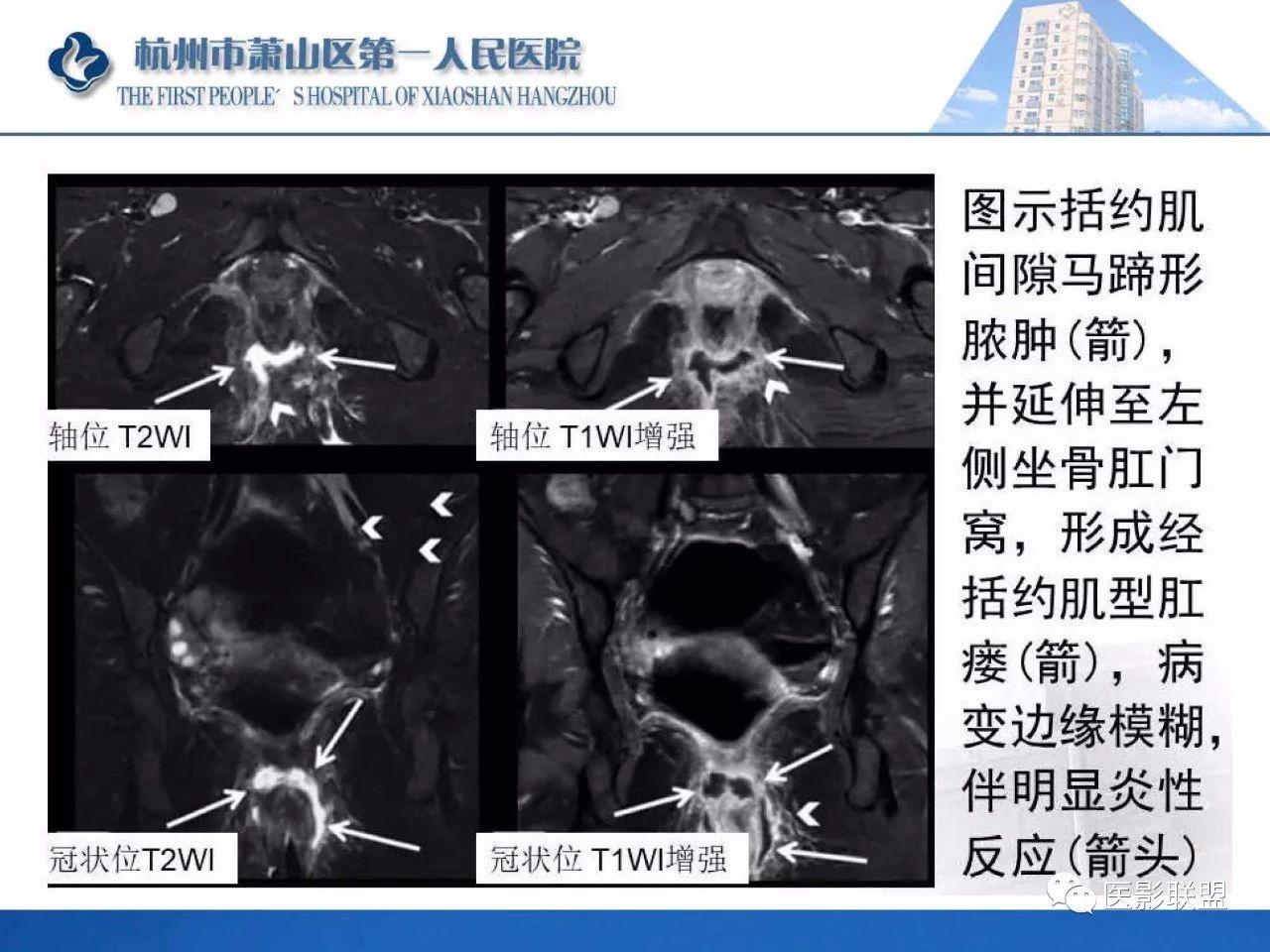 肛提肌mri图片