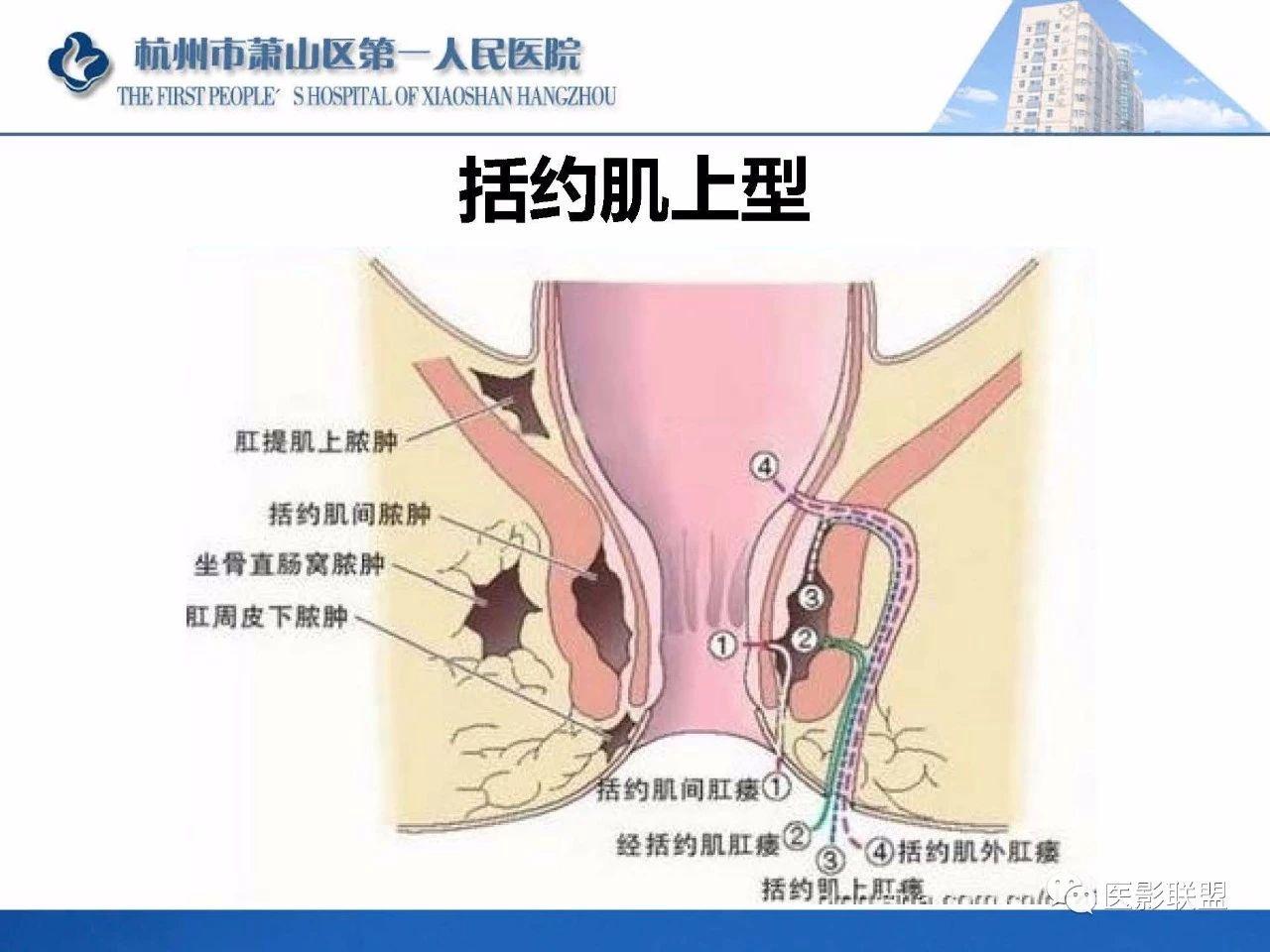 专业资源肛瘘的mri诊断