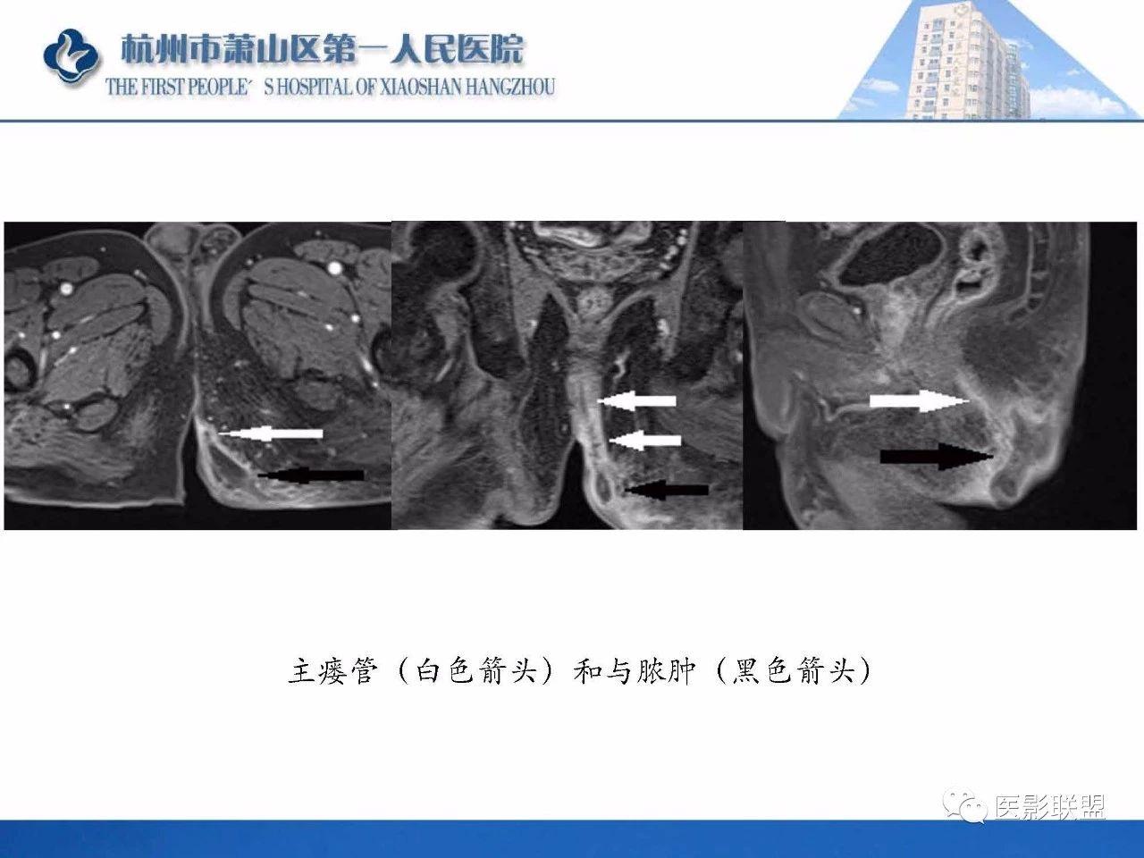 专业资源肛瘘的mri诊断