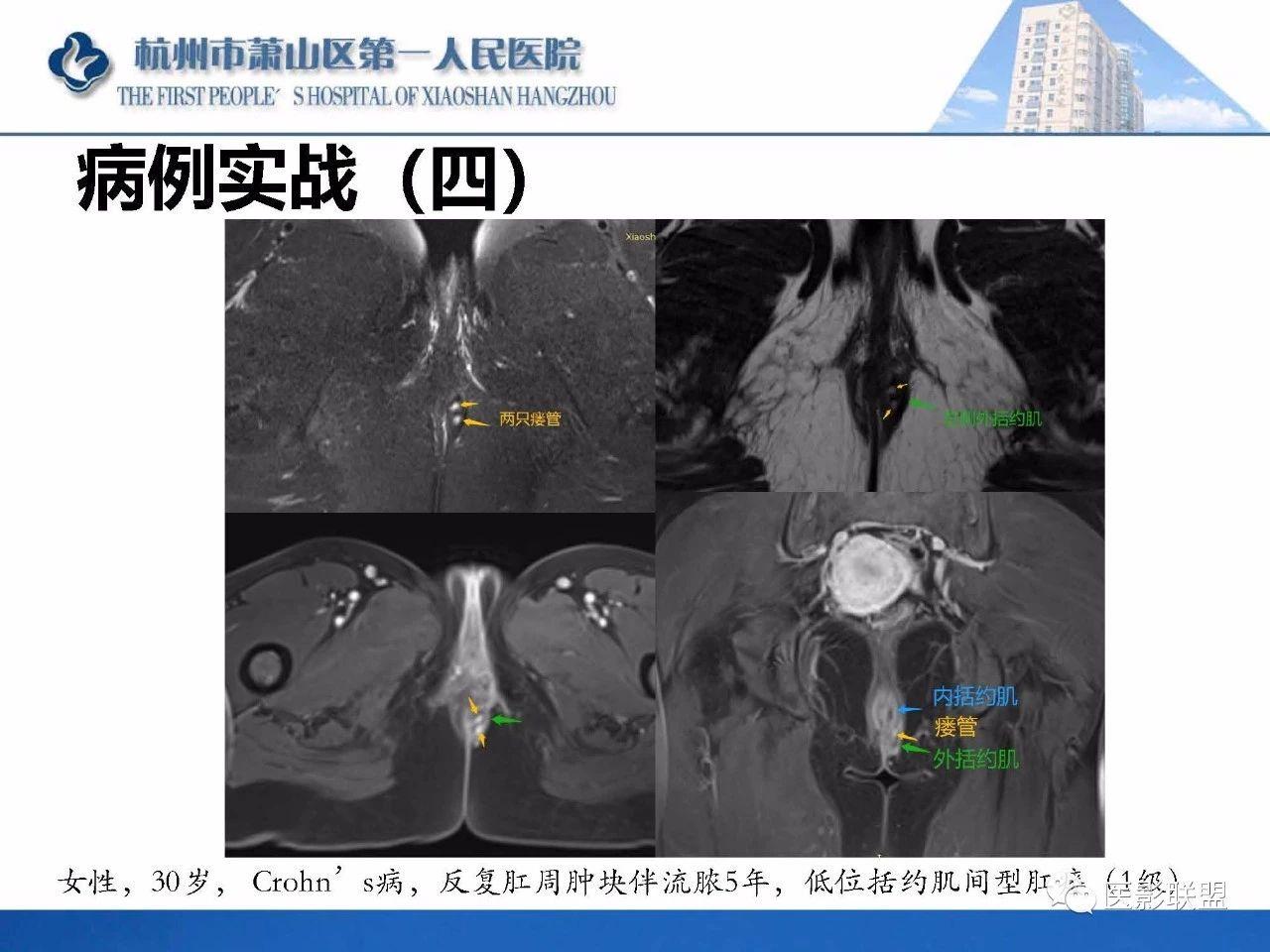 专业资源肛瘘的mri诊断