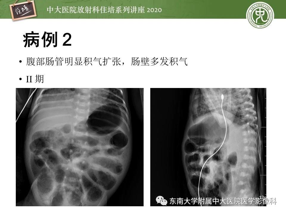 新生儿坏死性小肠结肠炎的影像学表现