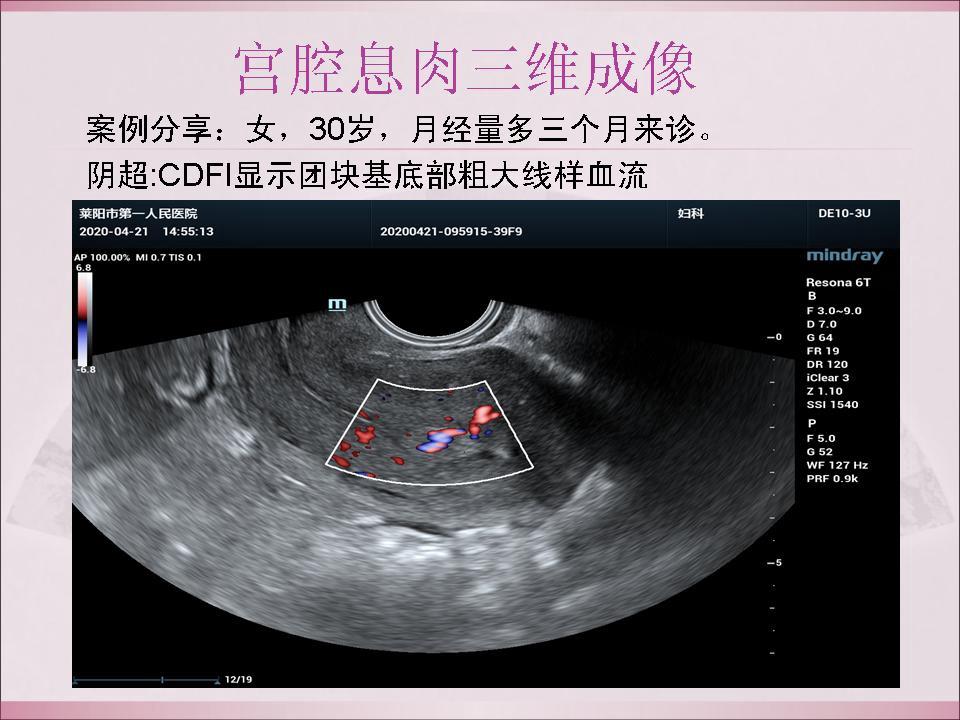 宮腔息肉三維成像