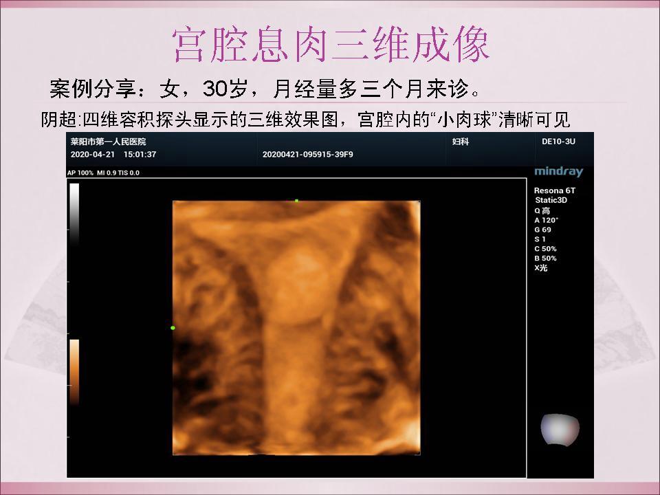 宮腔息肉三維成像