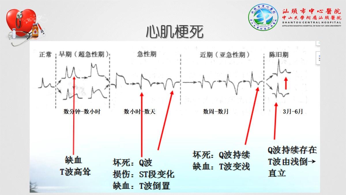 心肌梗死心律失常异常心电图大盘点