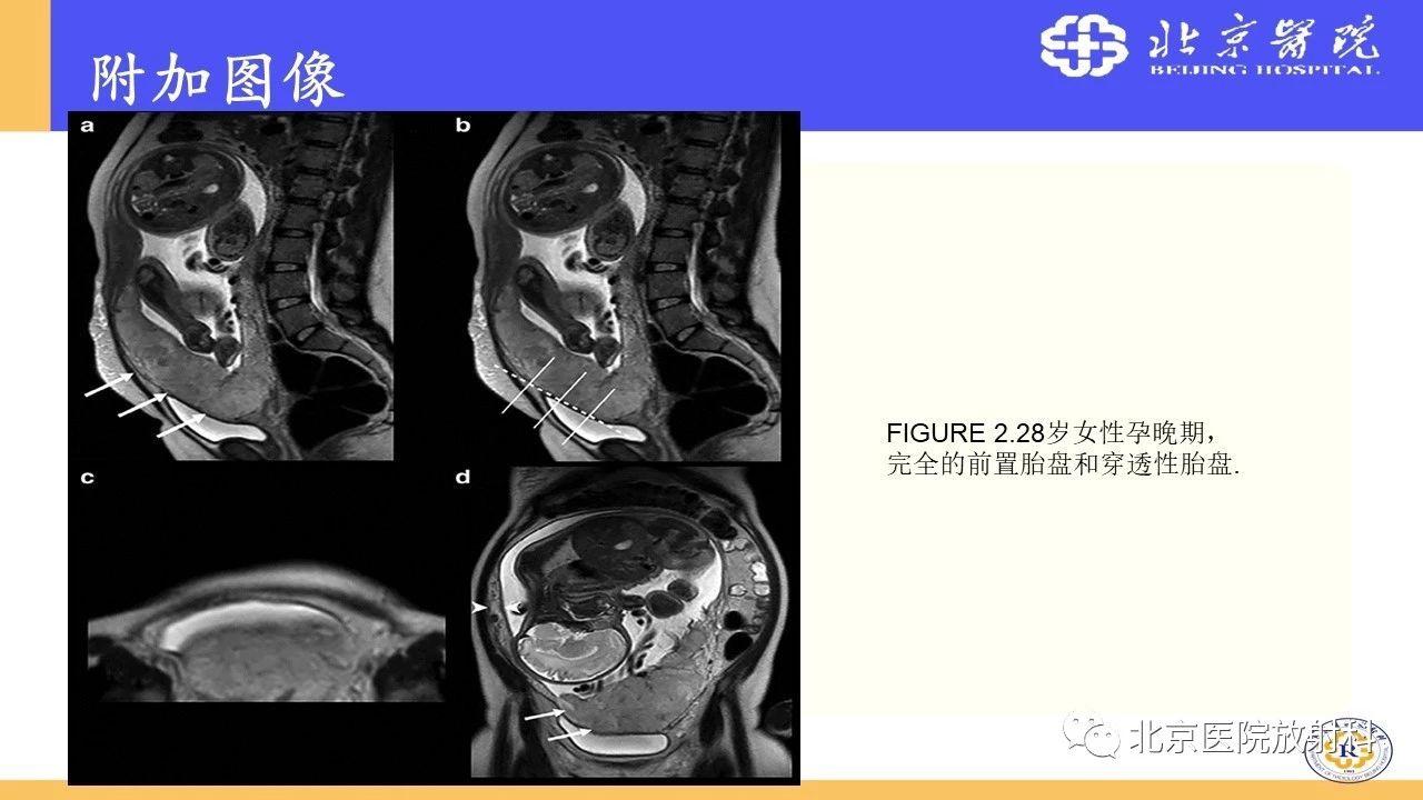什么叫植入性胎盘 200822171003np2p1ilh30ob4n5l.jpg