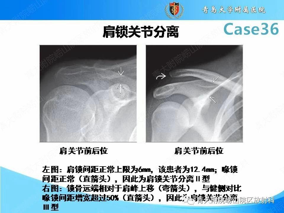 肩锁关节分离图片图片