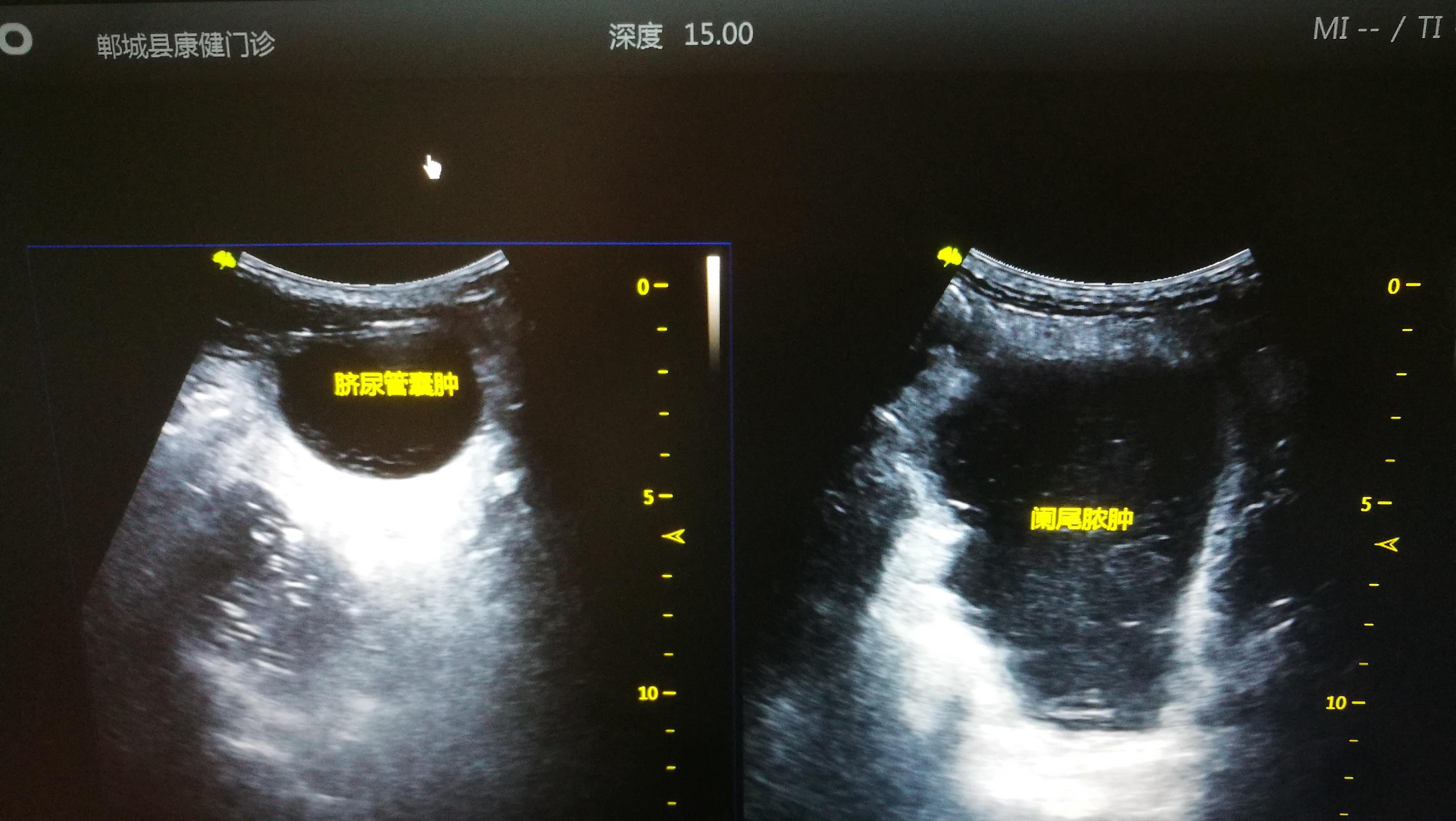 男28岁阑尾脓肿脐尿管囊肿