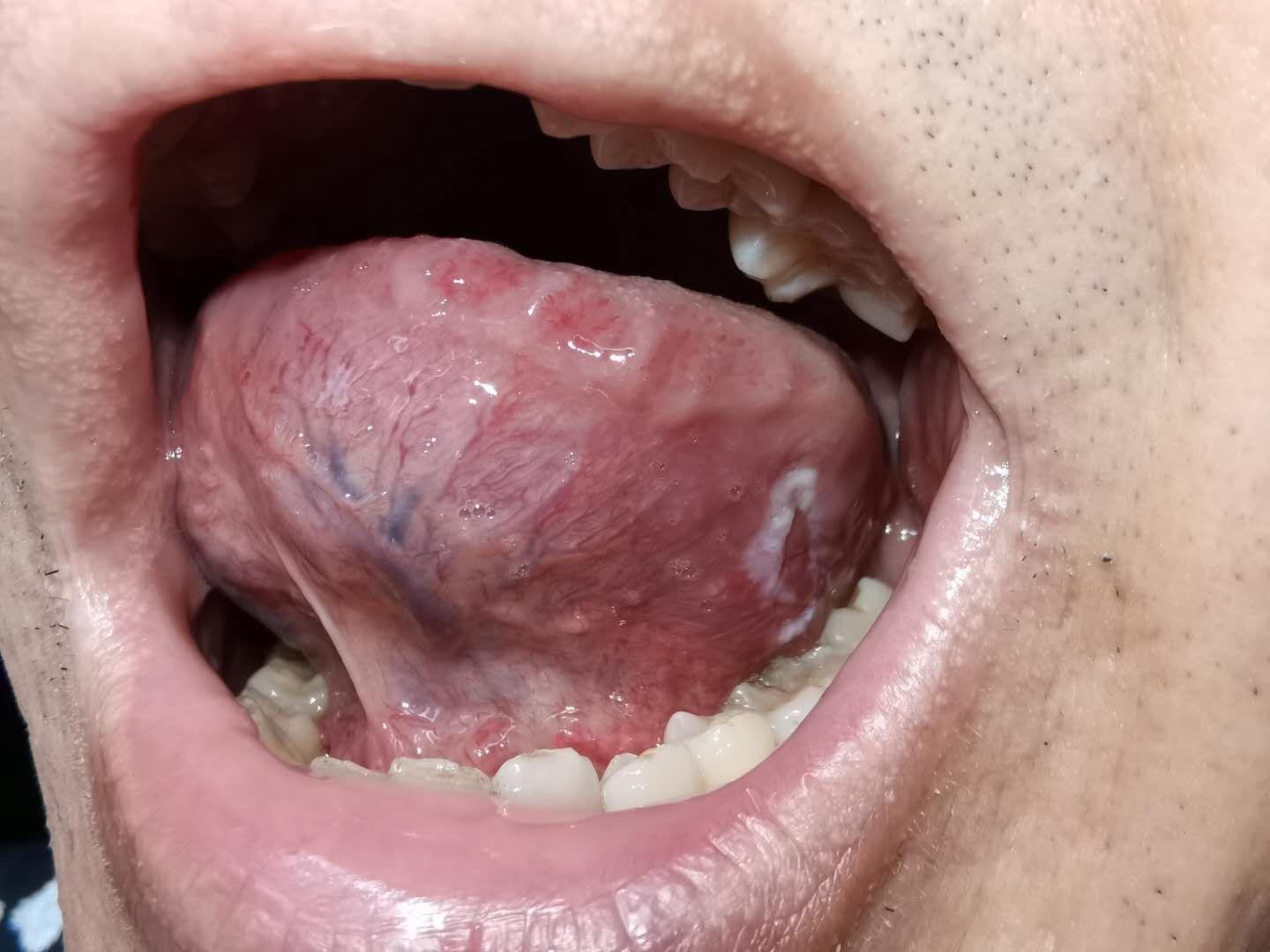 舌头溃疡 舌根图片
