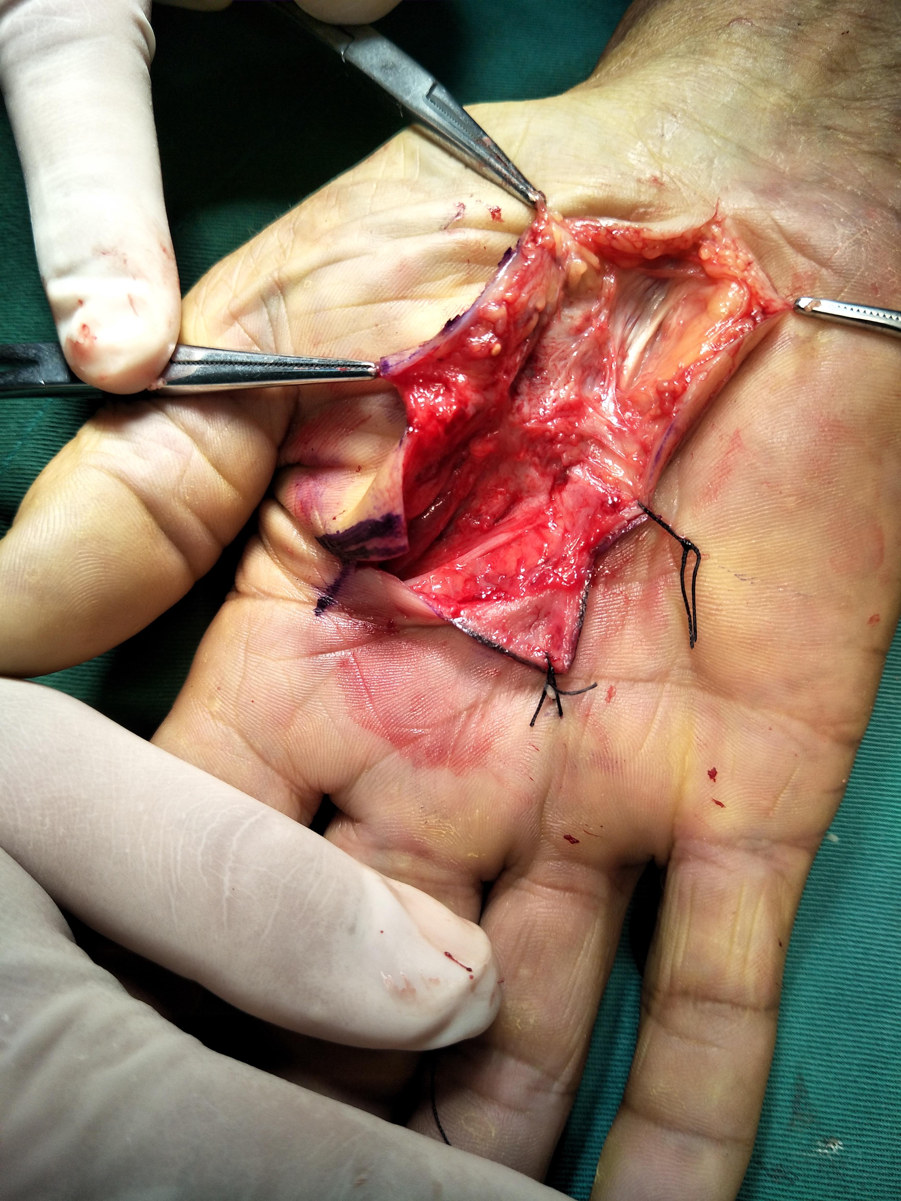 右手掌肿块z形切口设计