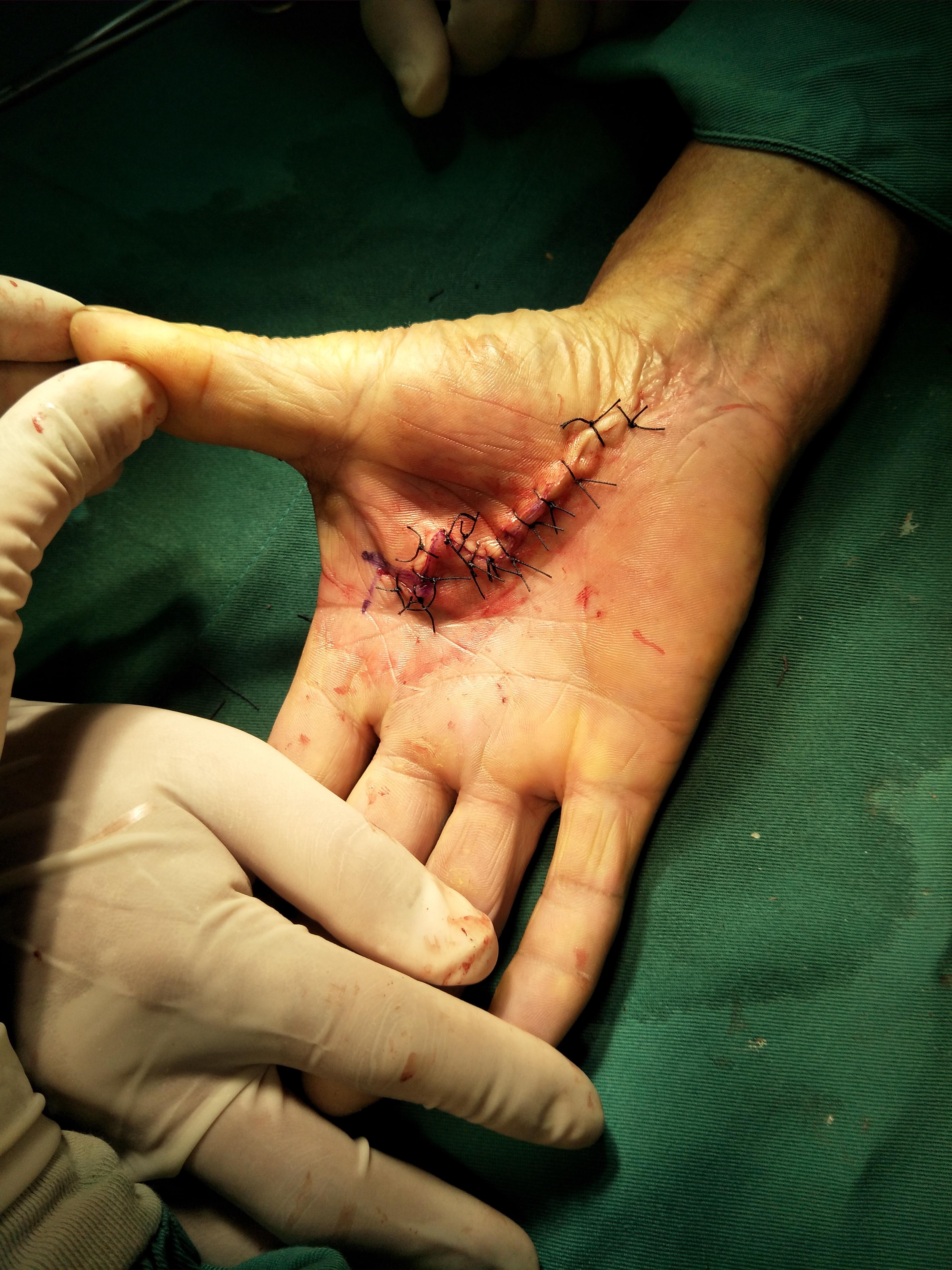 掌骨骨折手术图片