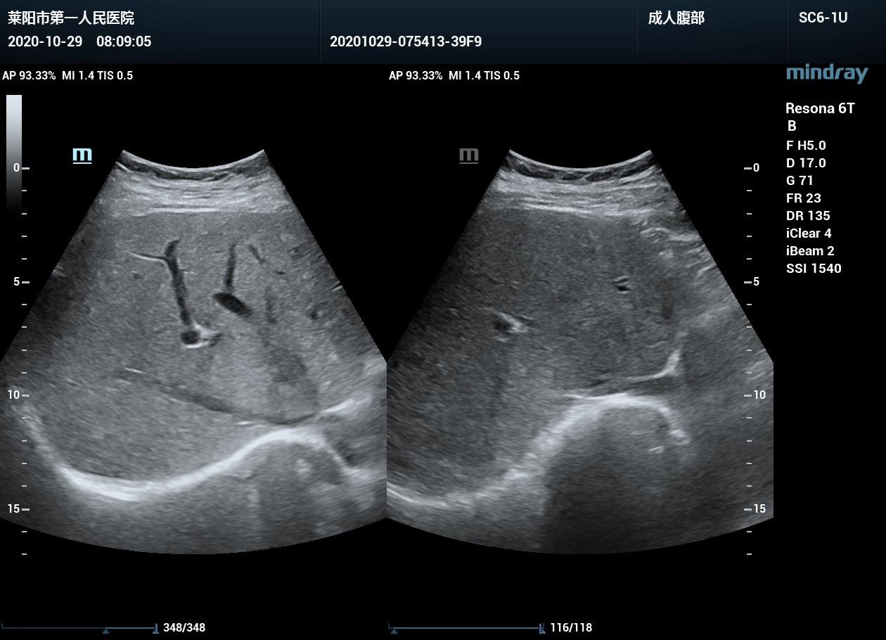超声入门贴1080胆总管多发结石左肝内胆管多发结石