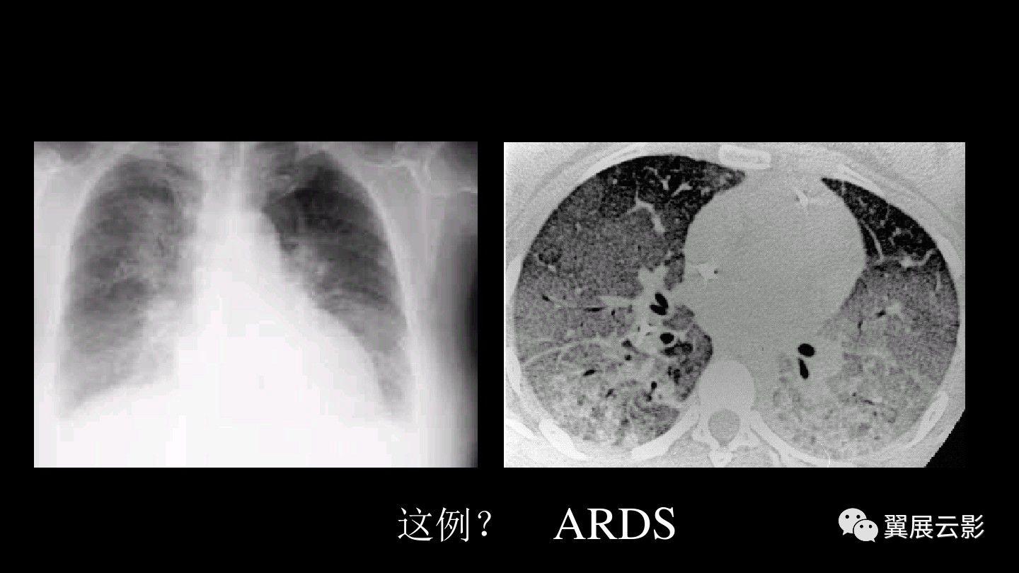 急性呼吸窘迫综合征的影像学表现