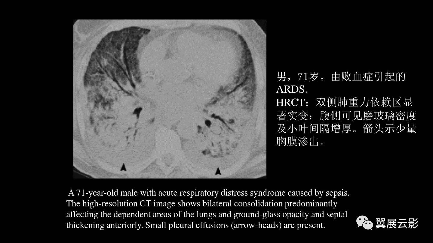 急性呼吸窘迫综合征的影像学表现
