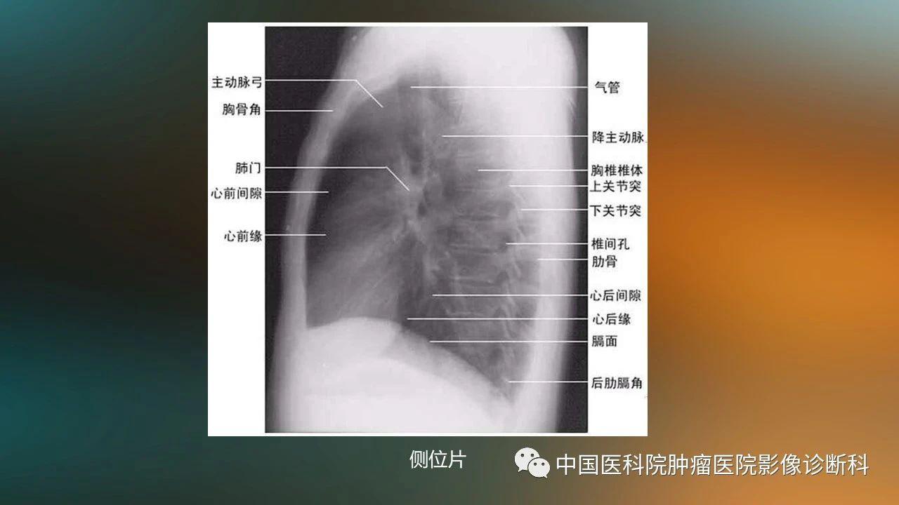 胸片解读示意图图片