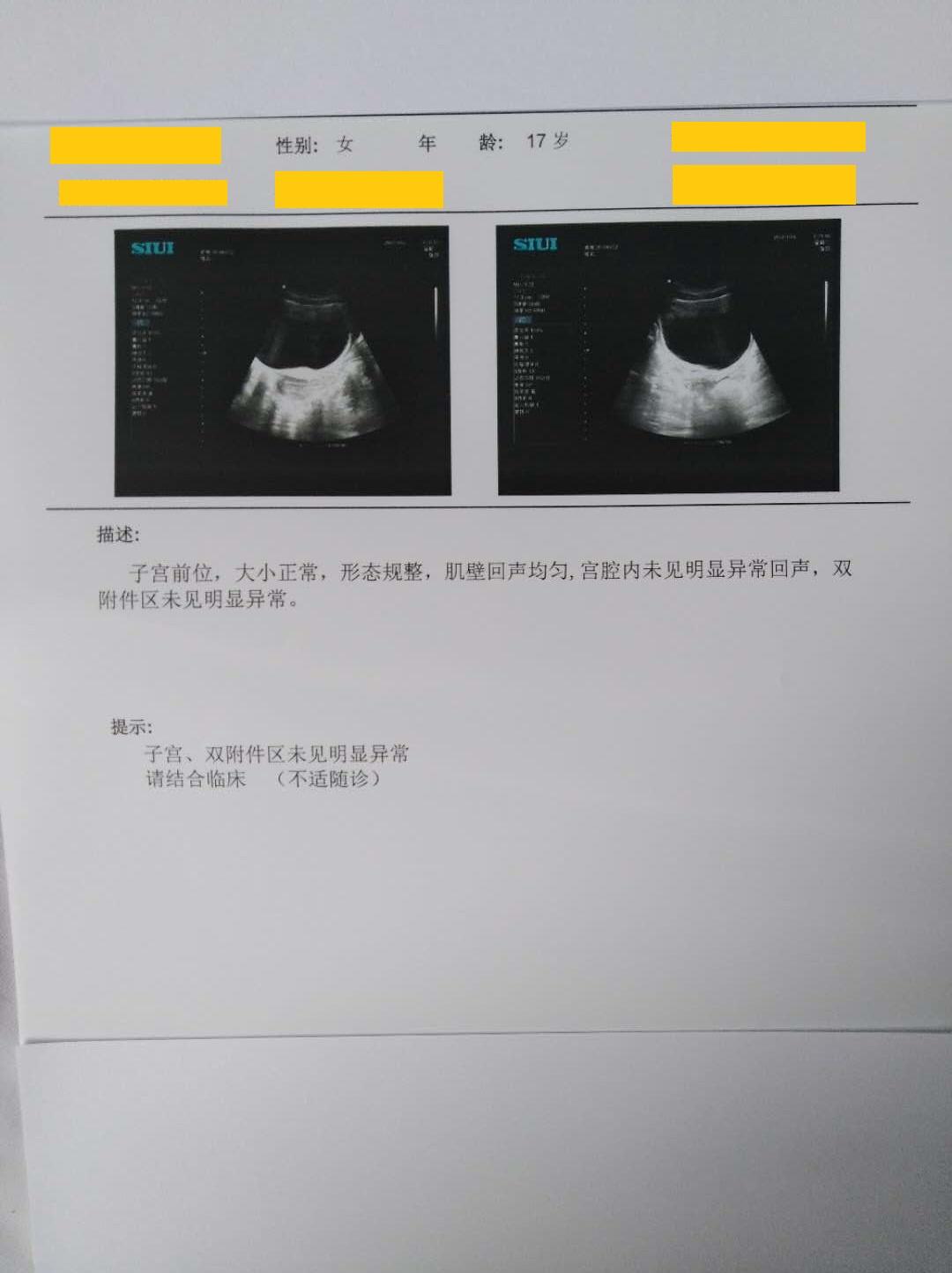 卵巢冠囊肿超声图片图片