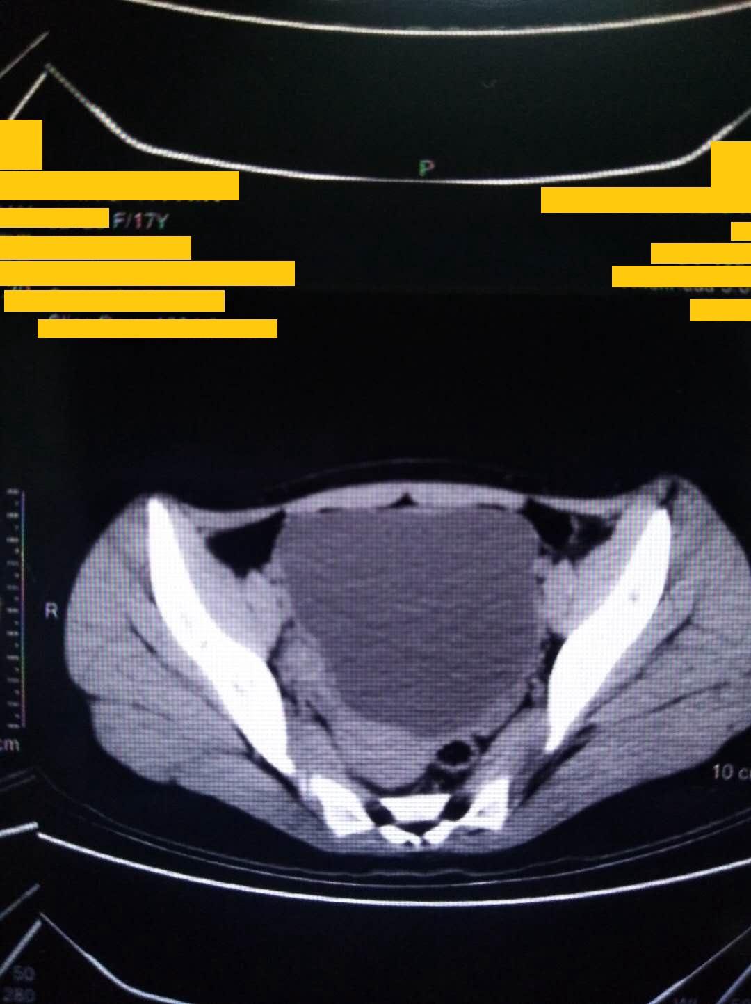 病例讨论:子宫前上方巨大囊性占位,右侧卵巢冠囊肿扭转
