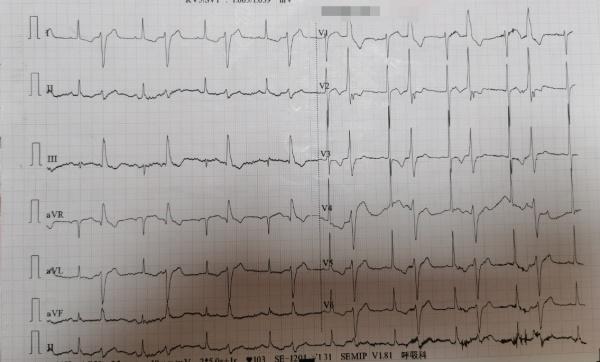 15号心电图