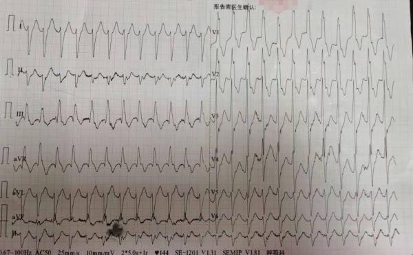 27号心电图