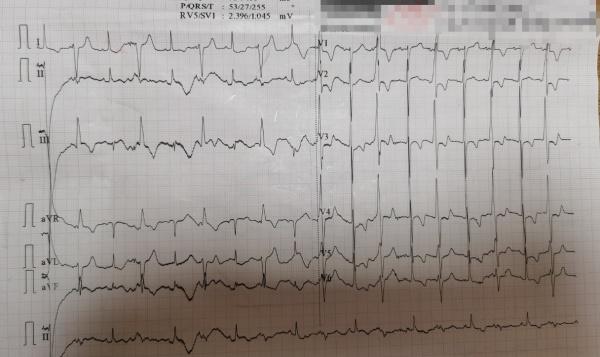 26号心电图