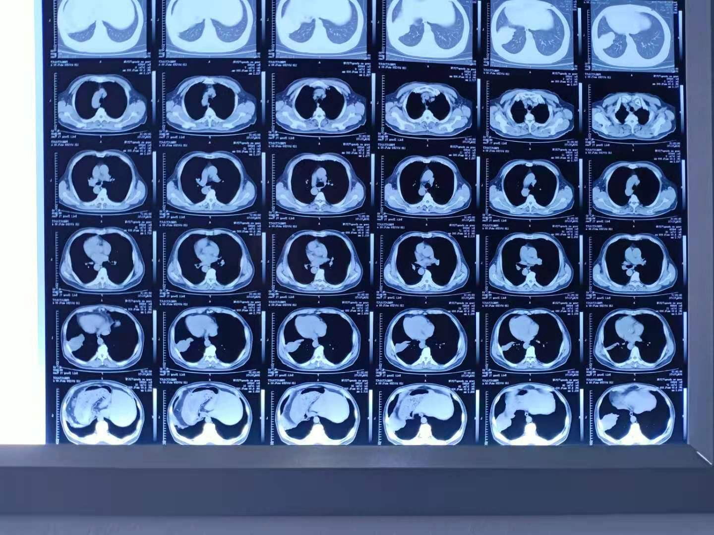 左肺下叶沿叶间裂高密度影 - 医学影像学讨论版 - 爱爱医医学论坛