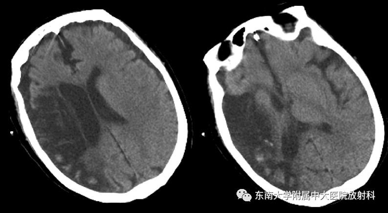 脑皮质层状坏死累及基底节