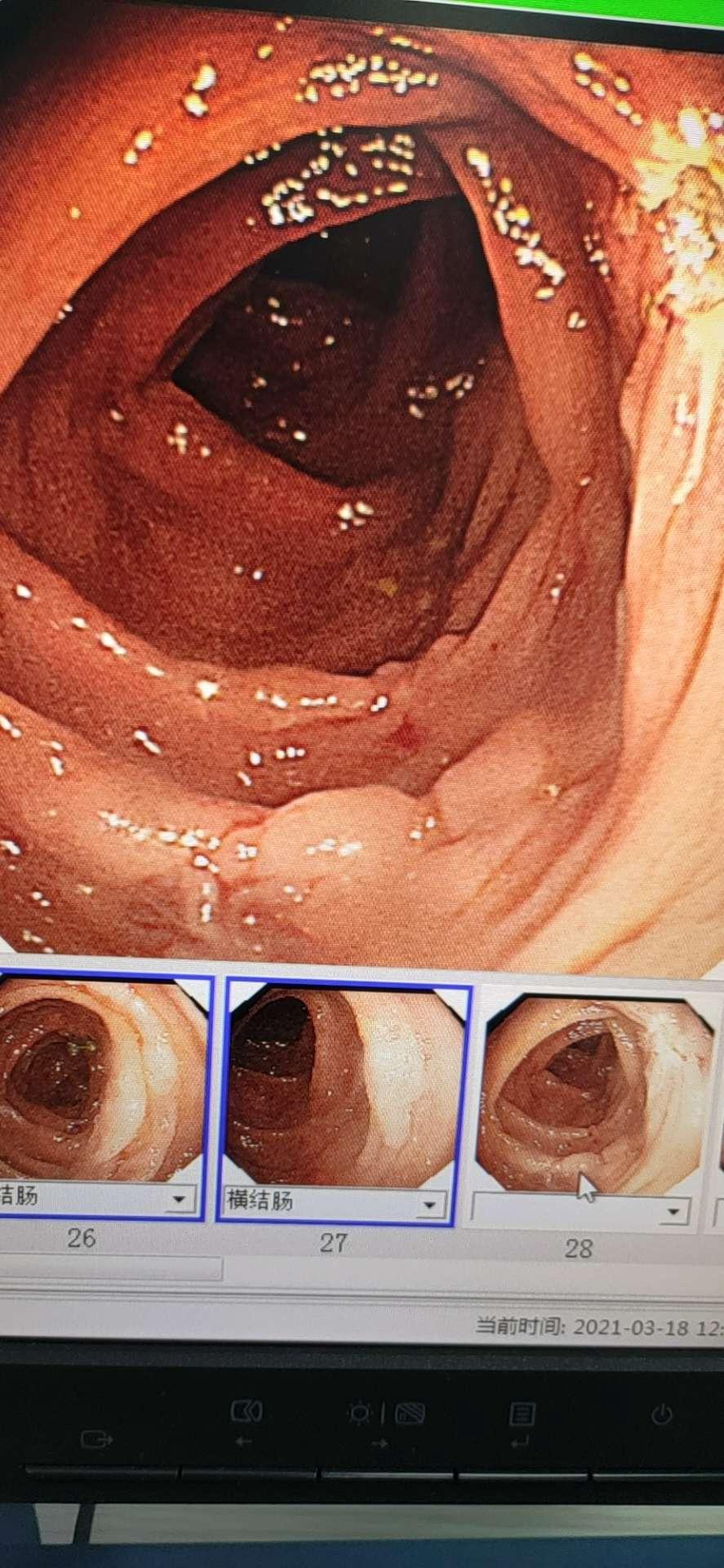 乙状结肠息肉癌症图片图片