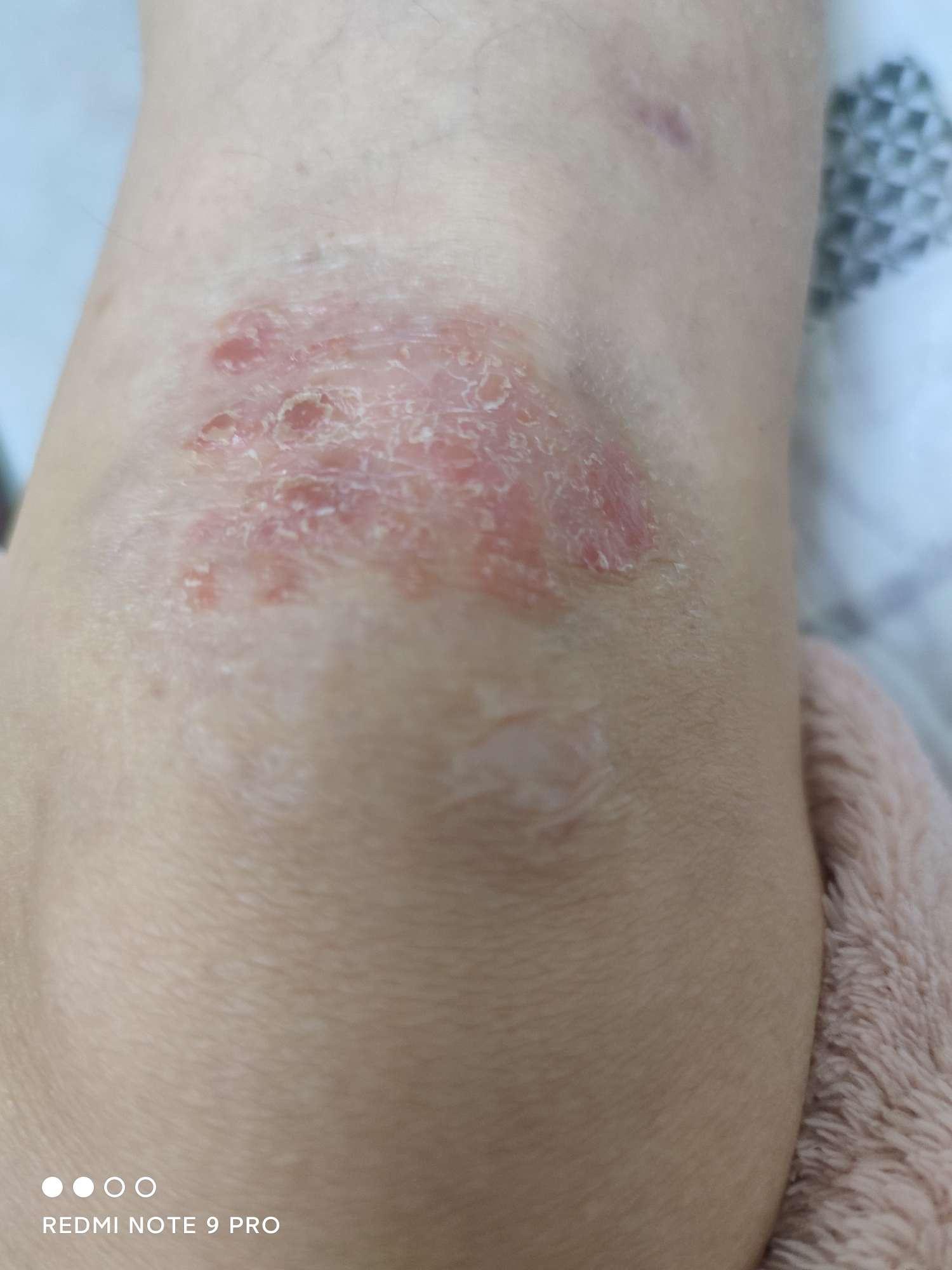 膝盖上不知道是藓还是湿疹