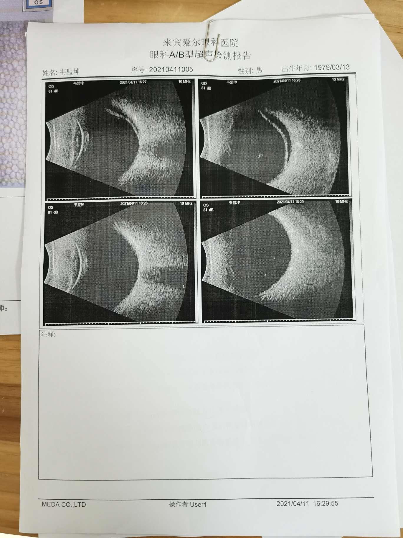 视网膜脱落非要手术不可吗