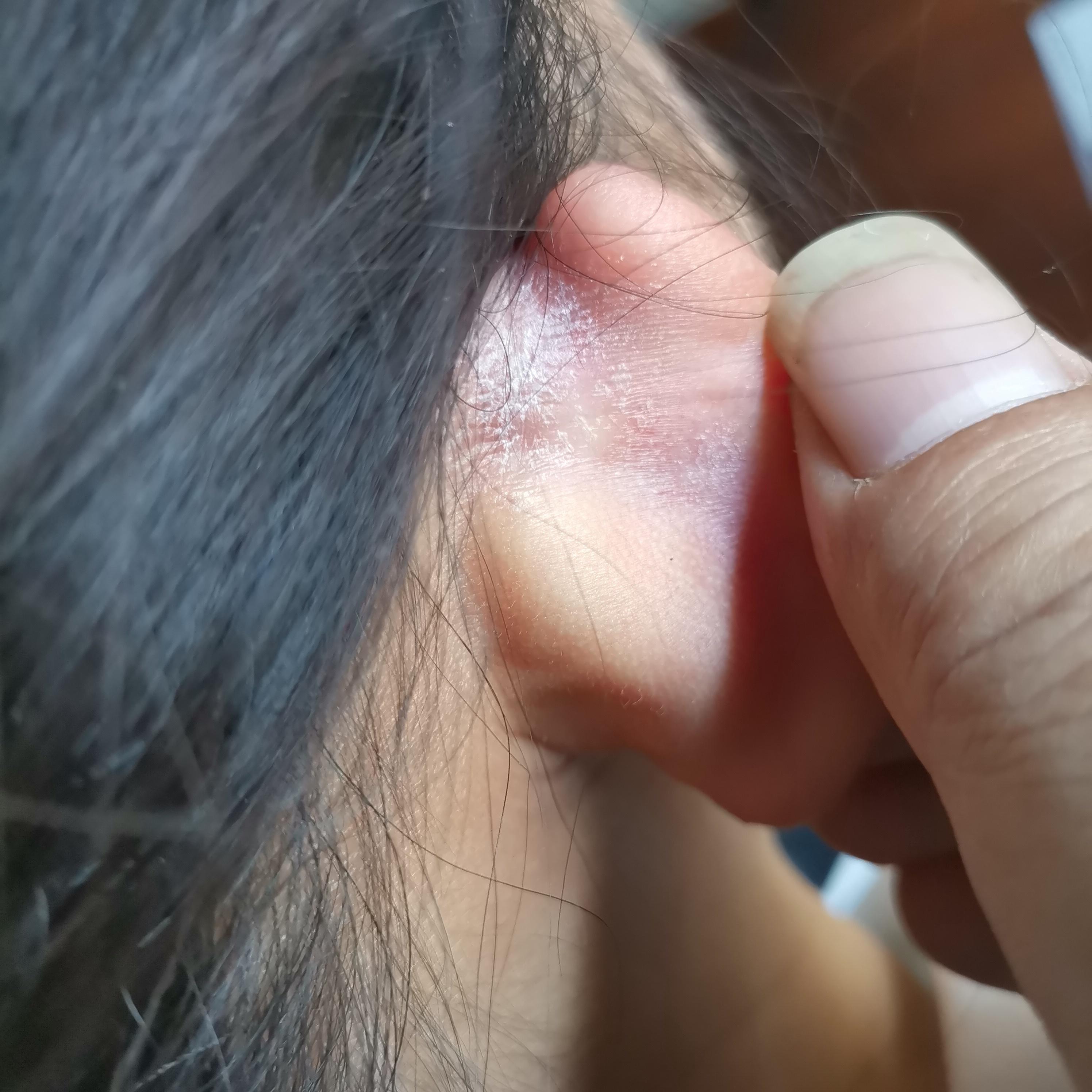 耳朵后面裂口是什么病