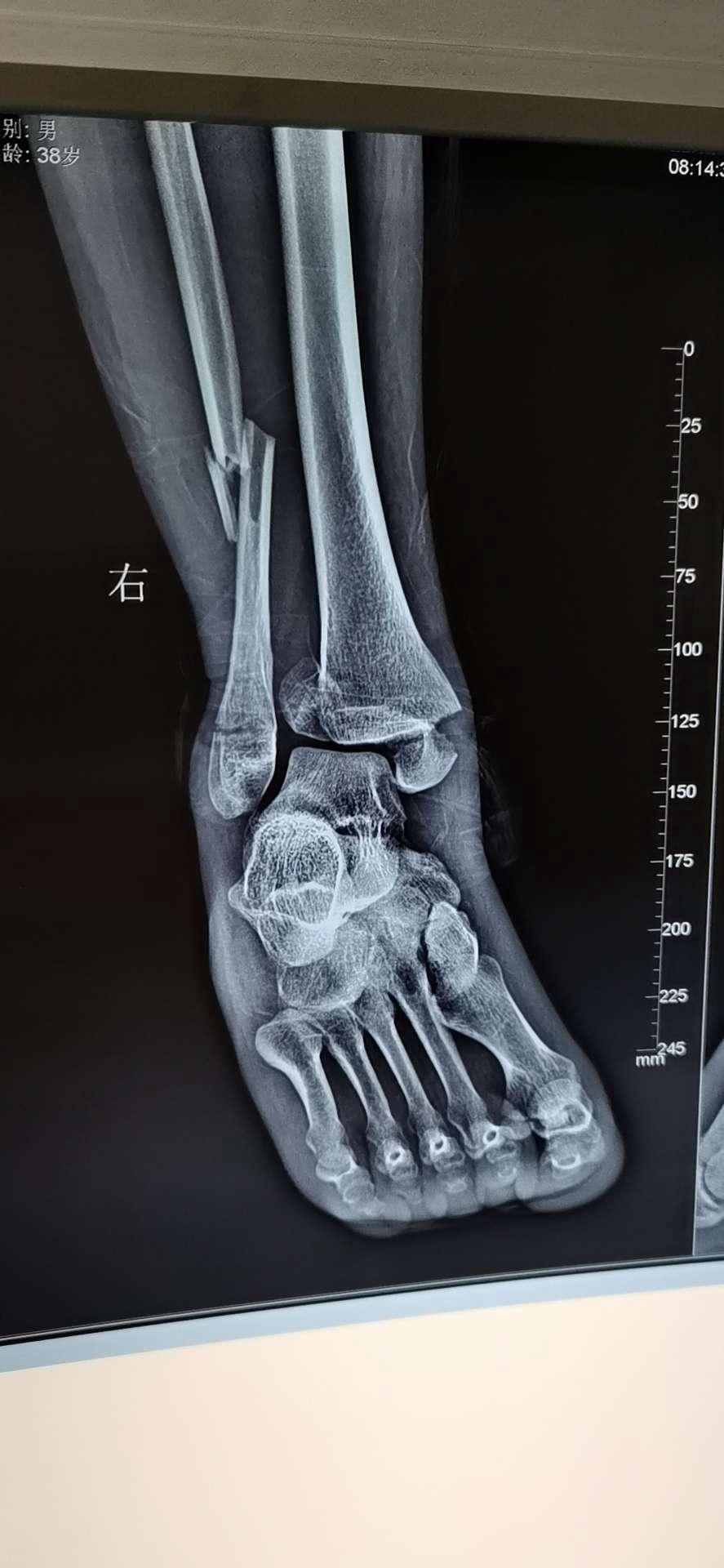 轻微左腿胫骨骨裂图片图片