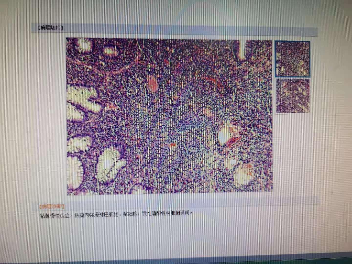 根据这种病理表现能够诊断肠结核吗