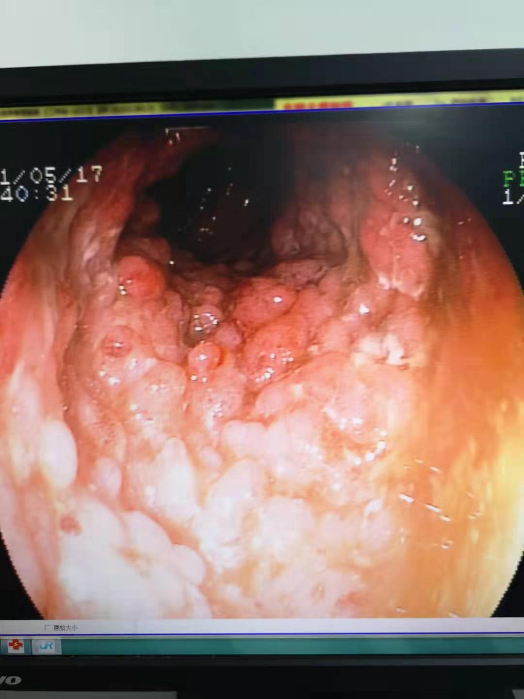 肠结核病理图片图片