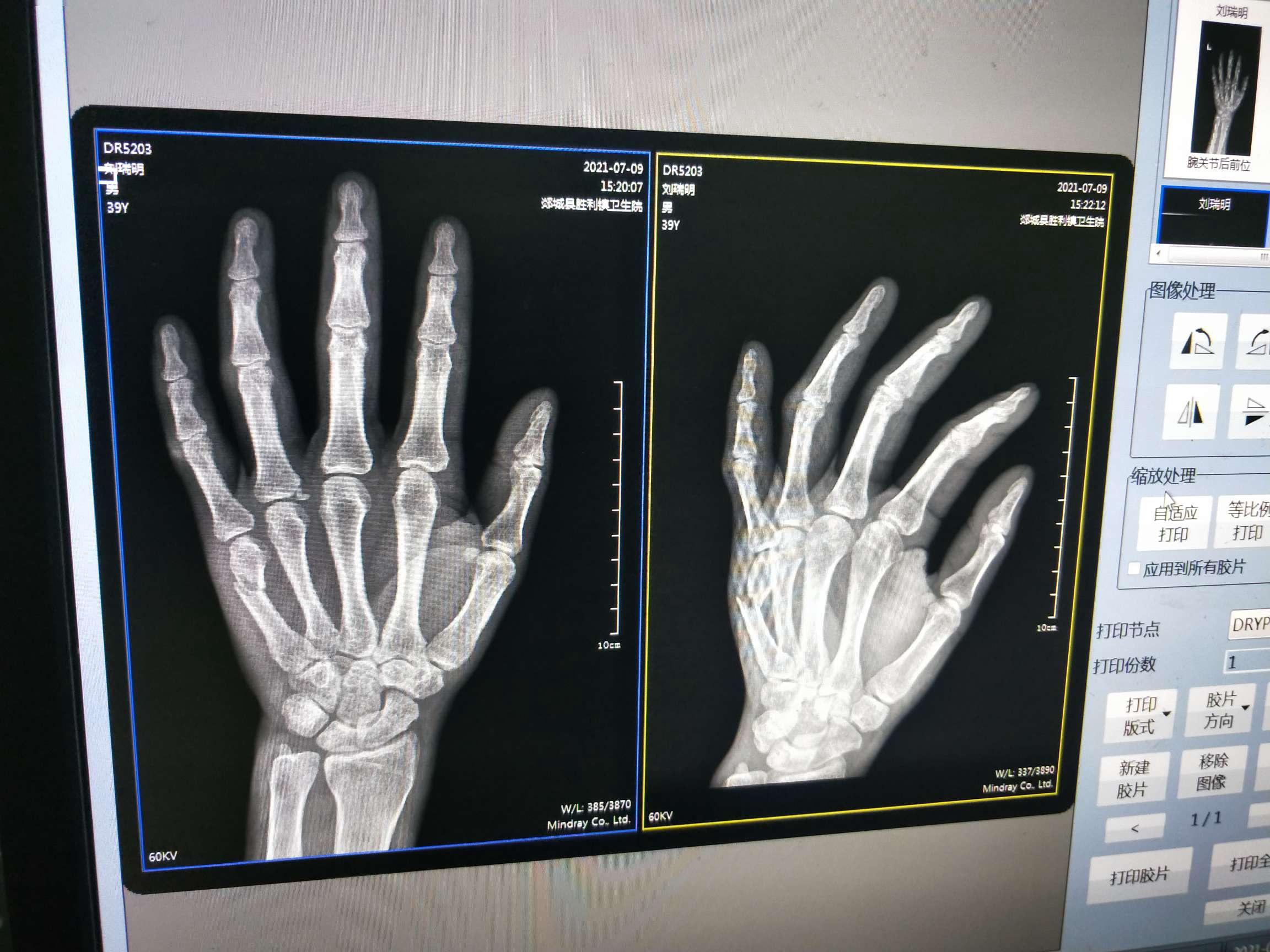 左手第五掌骨的位置图图片