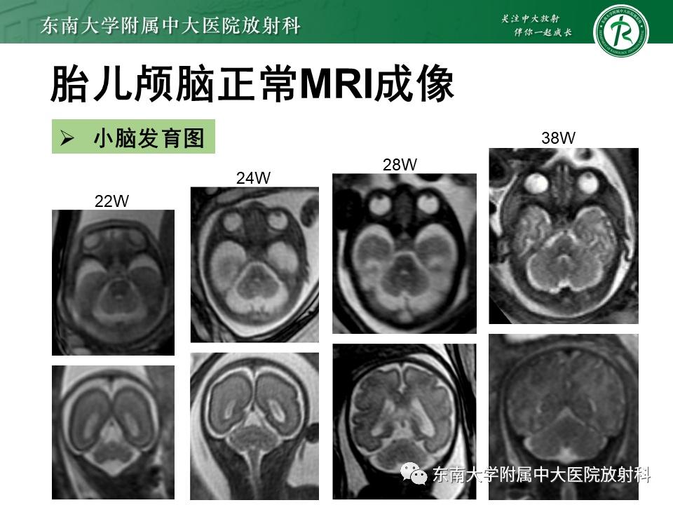 胎儿小脑图片