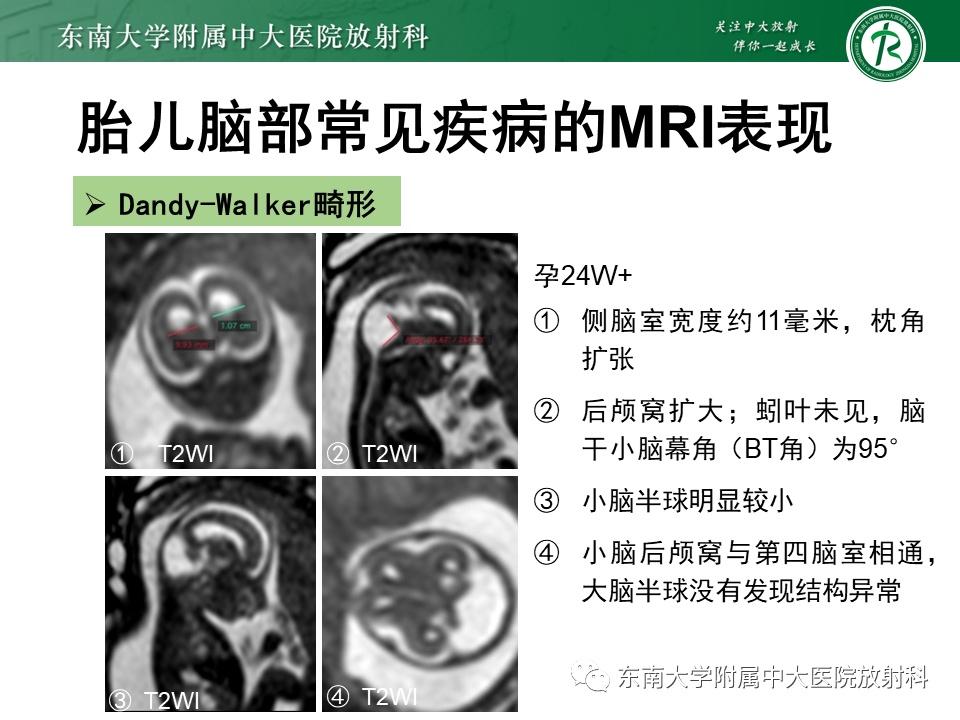 胎儿脑部先天性发育不良