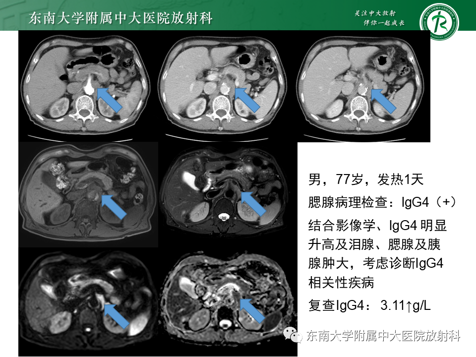 腹膜后纤维化(继发性)