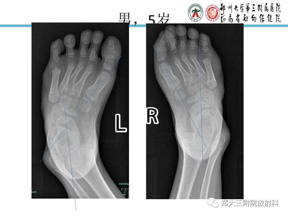 儿童足部x光片图片