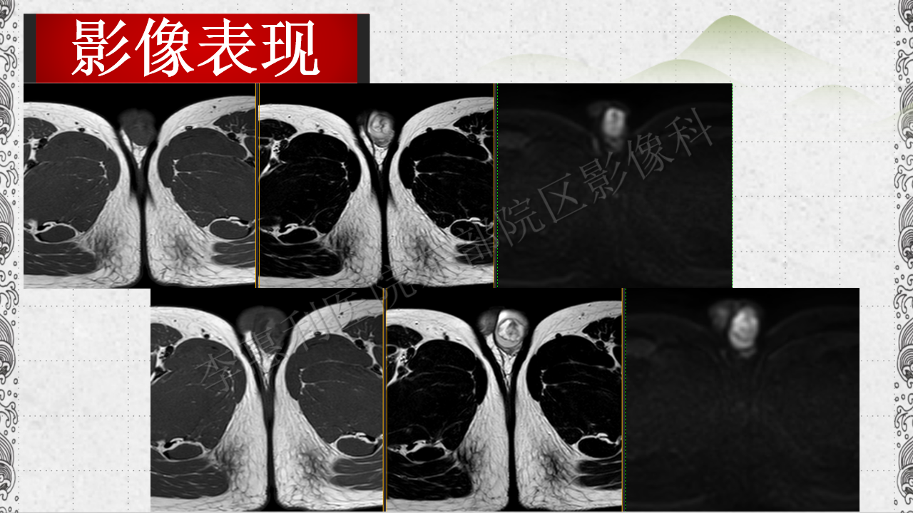 睾丸表皮样囊肿