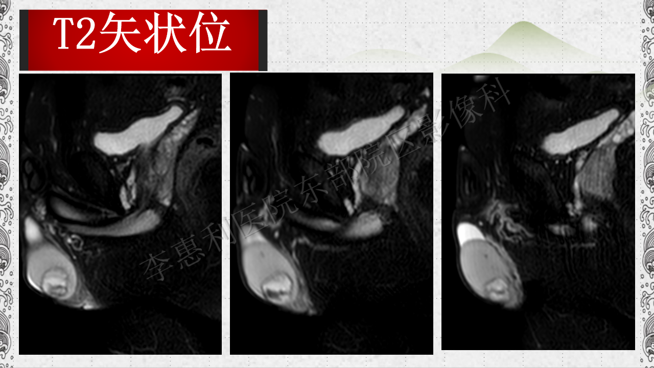 睾丸表皮样囊肿
