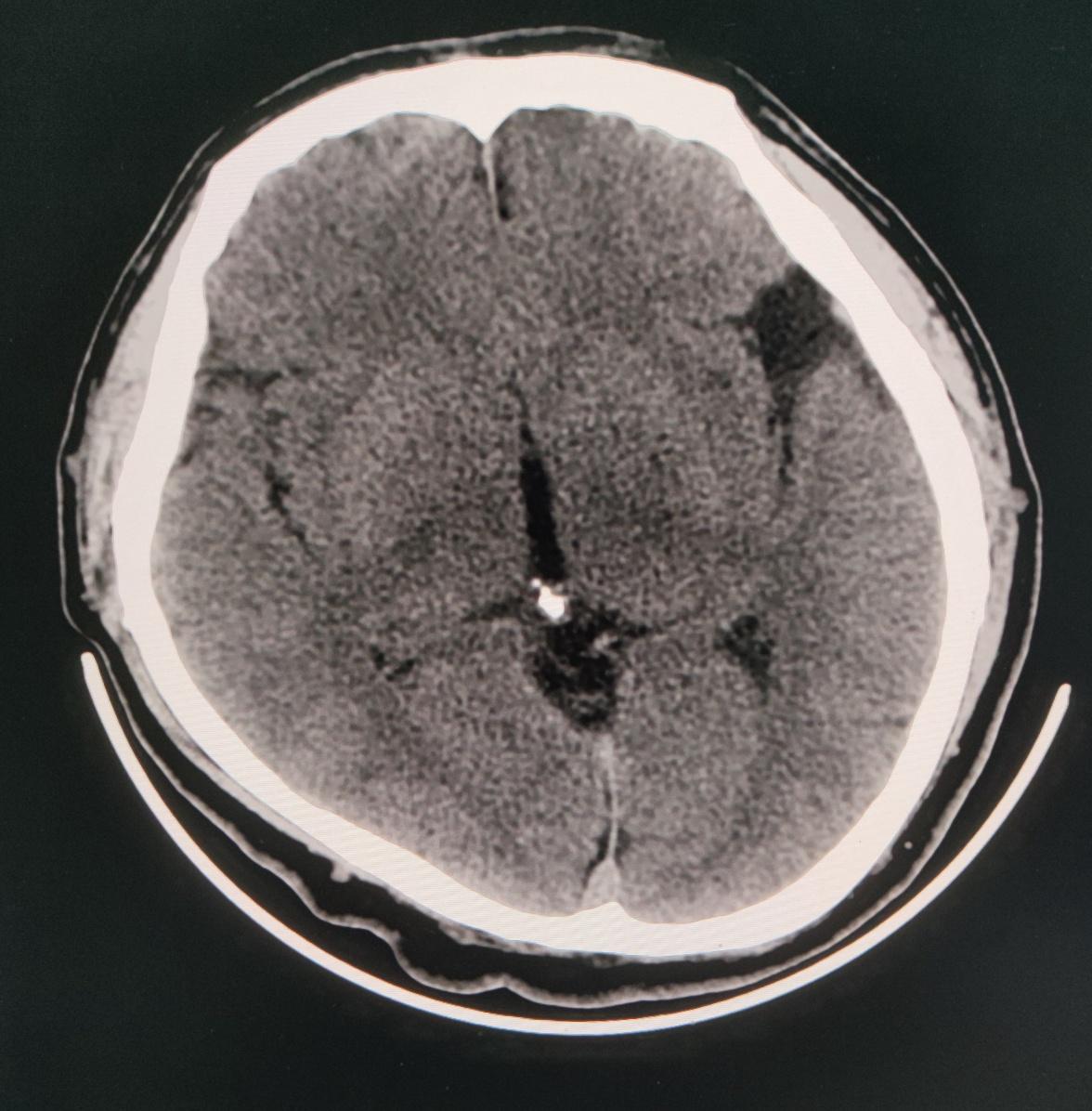 请教一下这个头颅左侧裂池局部增宽有问题吗怎么报