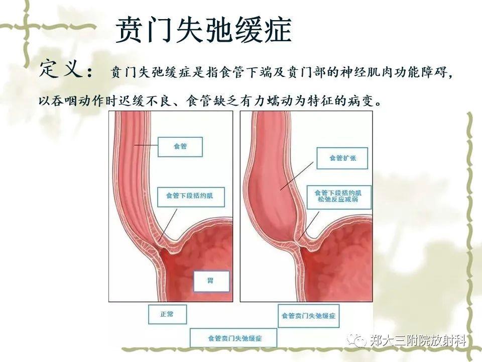 贲门失弛缓症影像图片图片