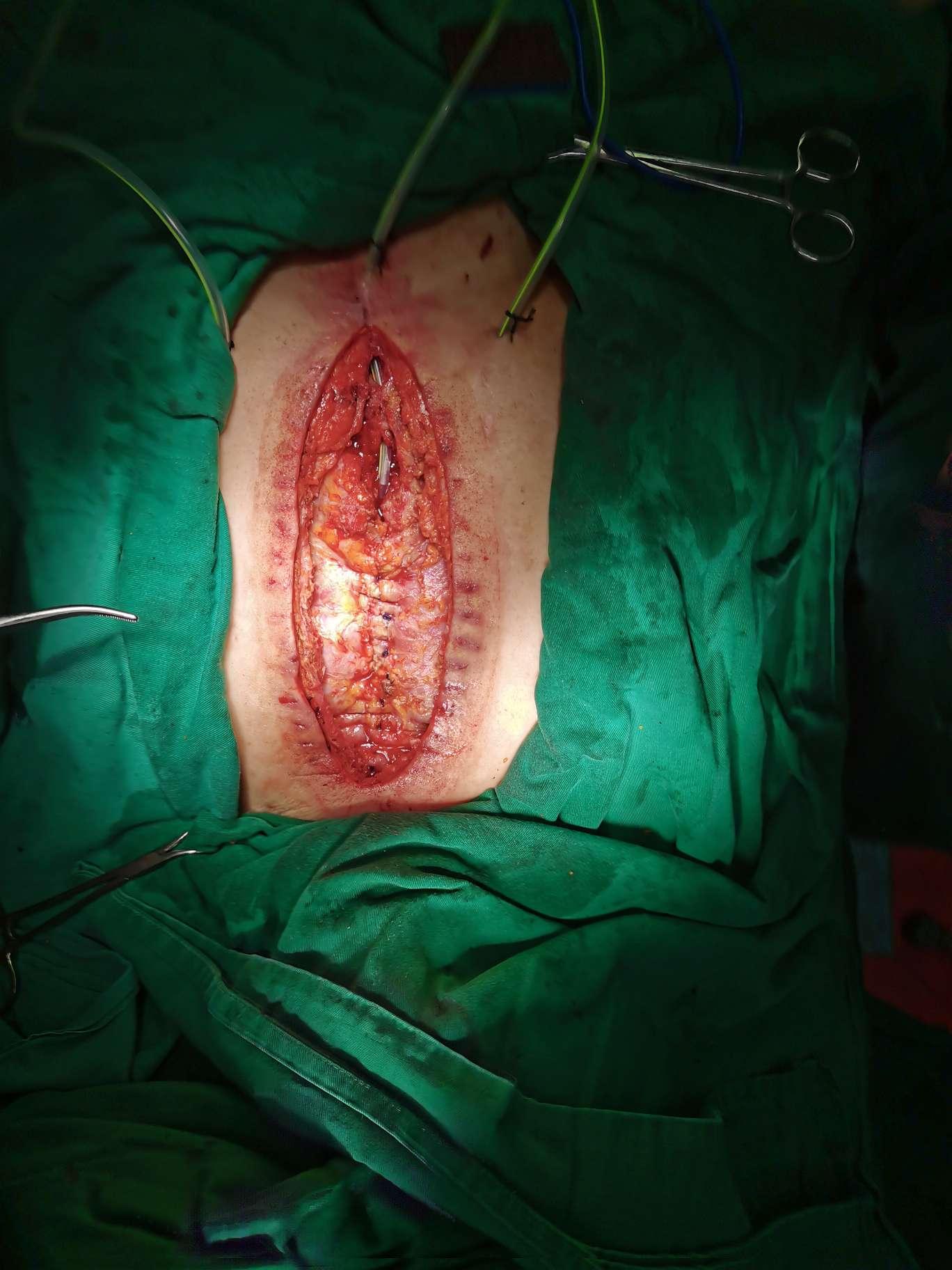 心脏术后重度伤口感染外科清创一期治愈手术