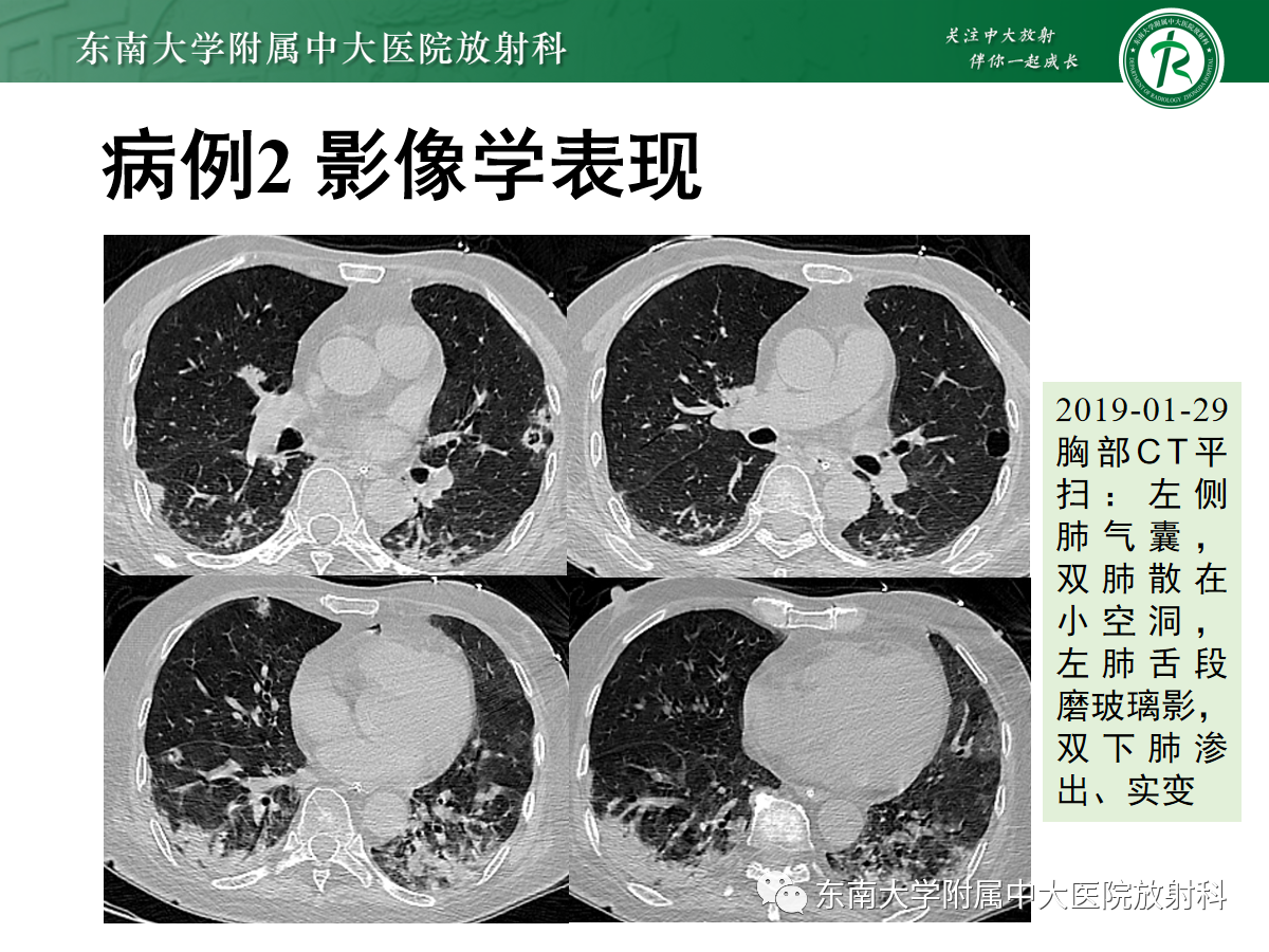 金葡菌感染图片