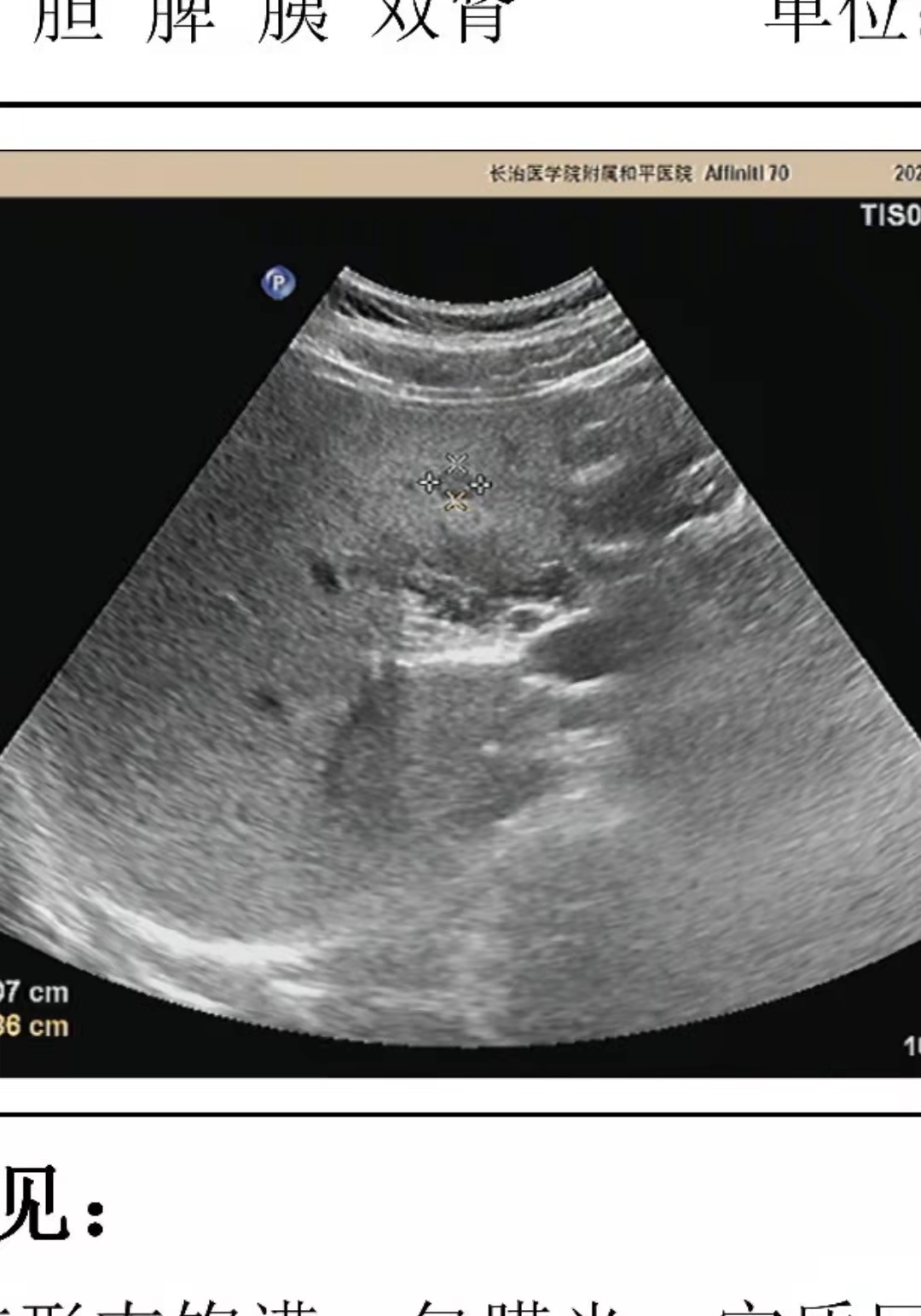 肝部彩超图片