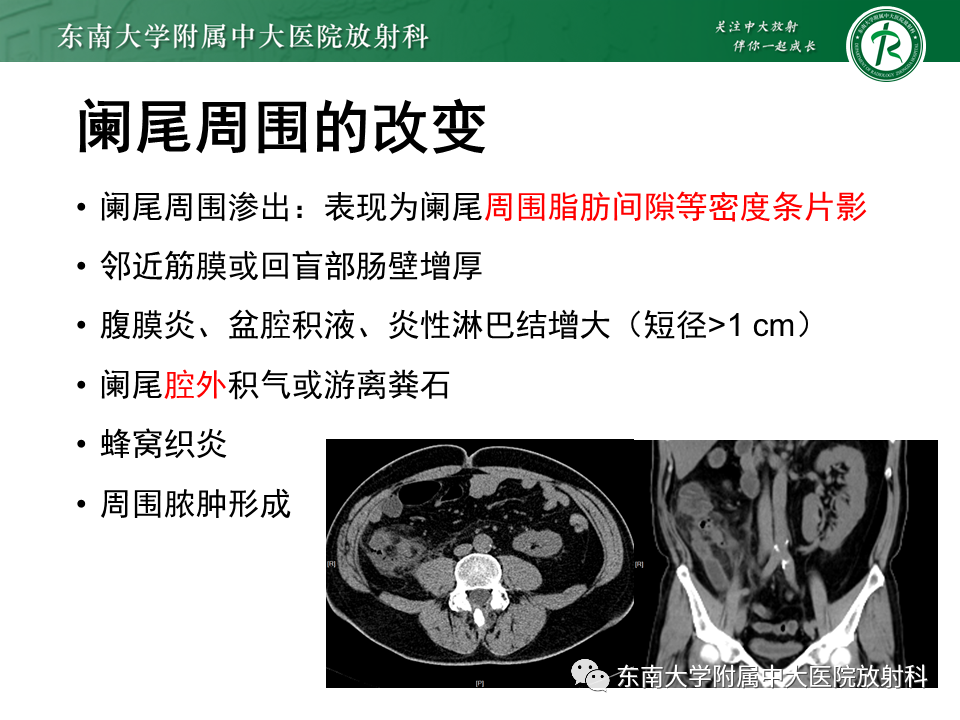 急性阑尾炎病理生理图图片