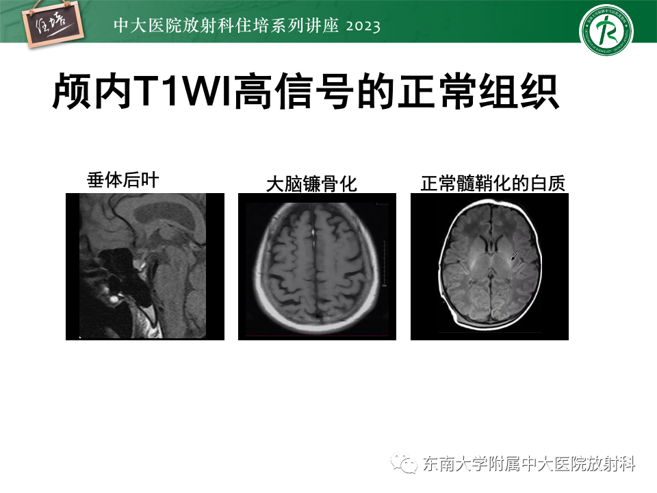 放射住培：成人颅内T1WI高信号病变分析思路