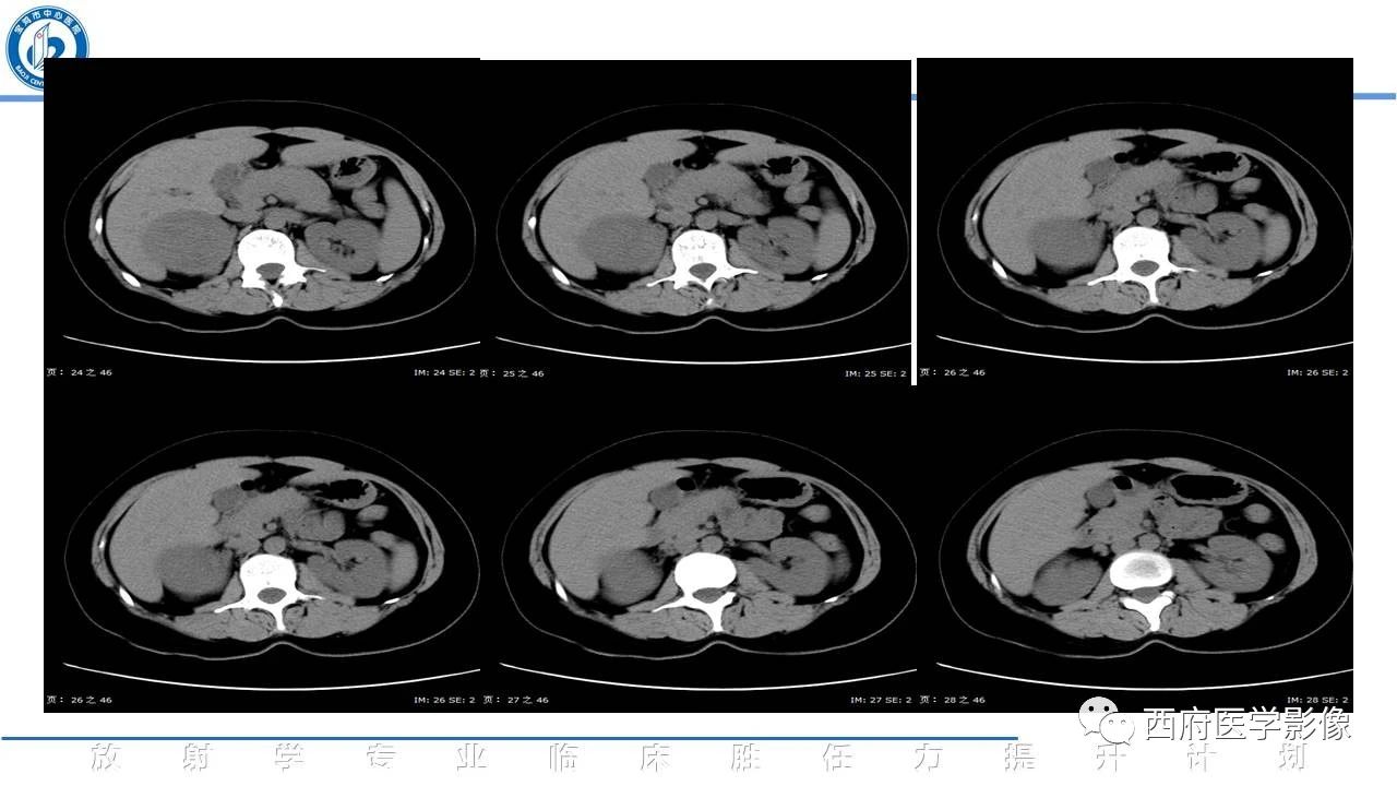 肾上腺嗜酸细胞腺瘤的影像表现与鉴别