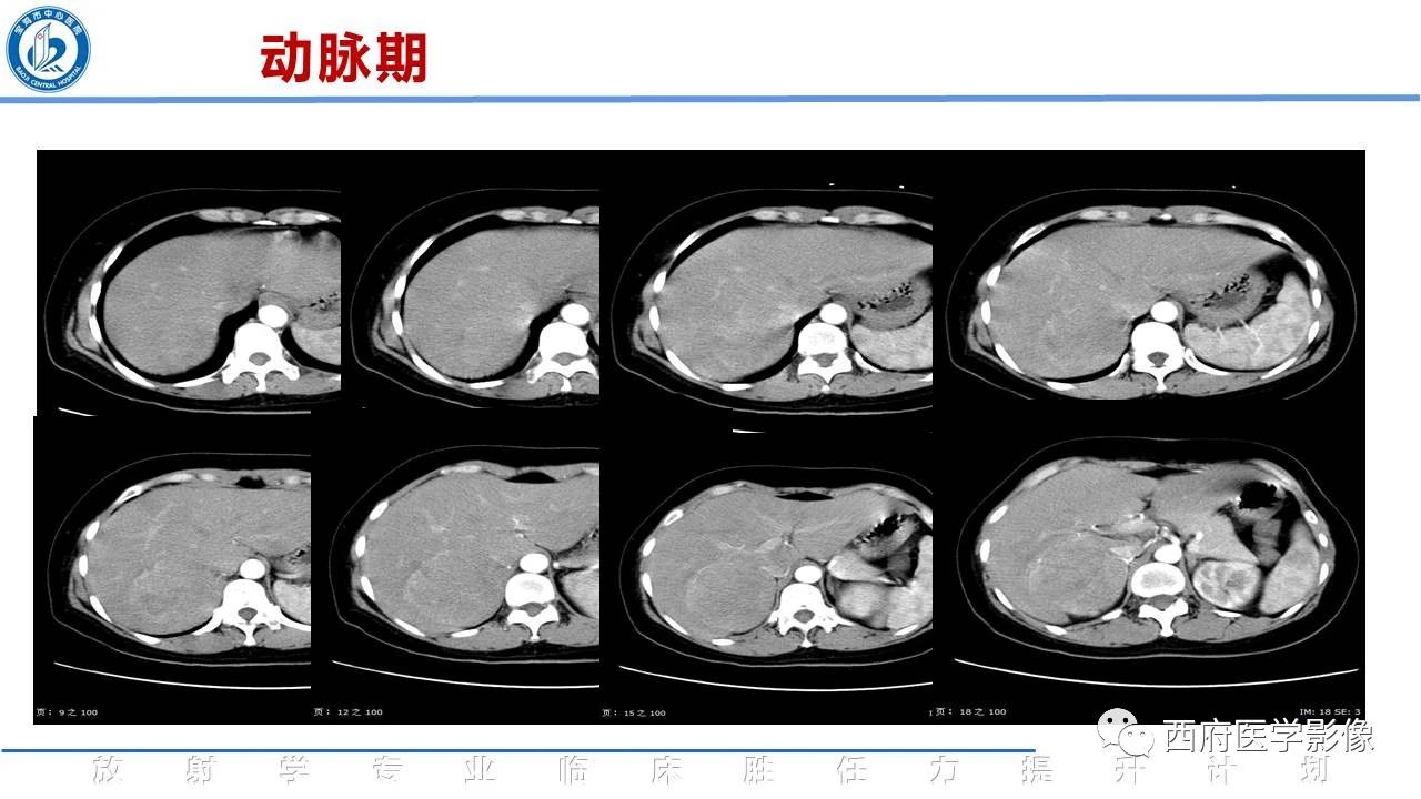 肾上腺嗜酸细胞腺瘤的影像表现与鉴别
