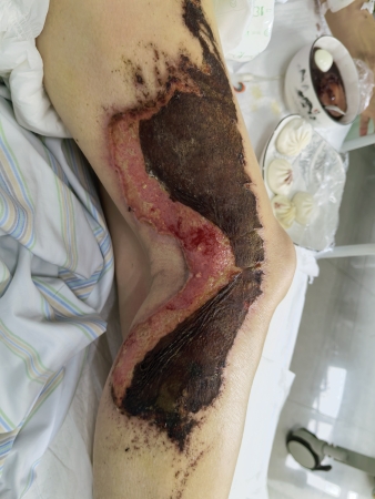 右下肢皮肤坏死图片2